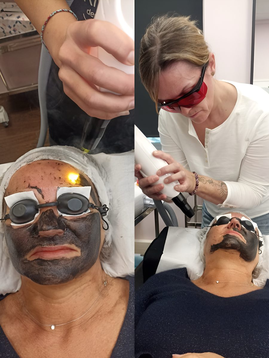 Soin du visage à la lumière pulsée